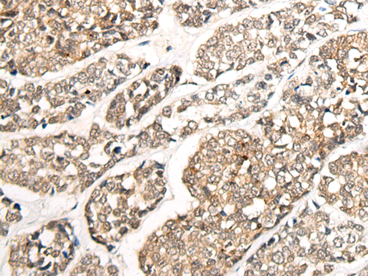 Immunohistochemistry of paraffin-embedded Human esophagus cancer tissue  using CCDC181 Polyclonal Antibody at dilution of 1:50(×200)