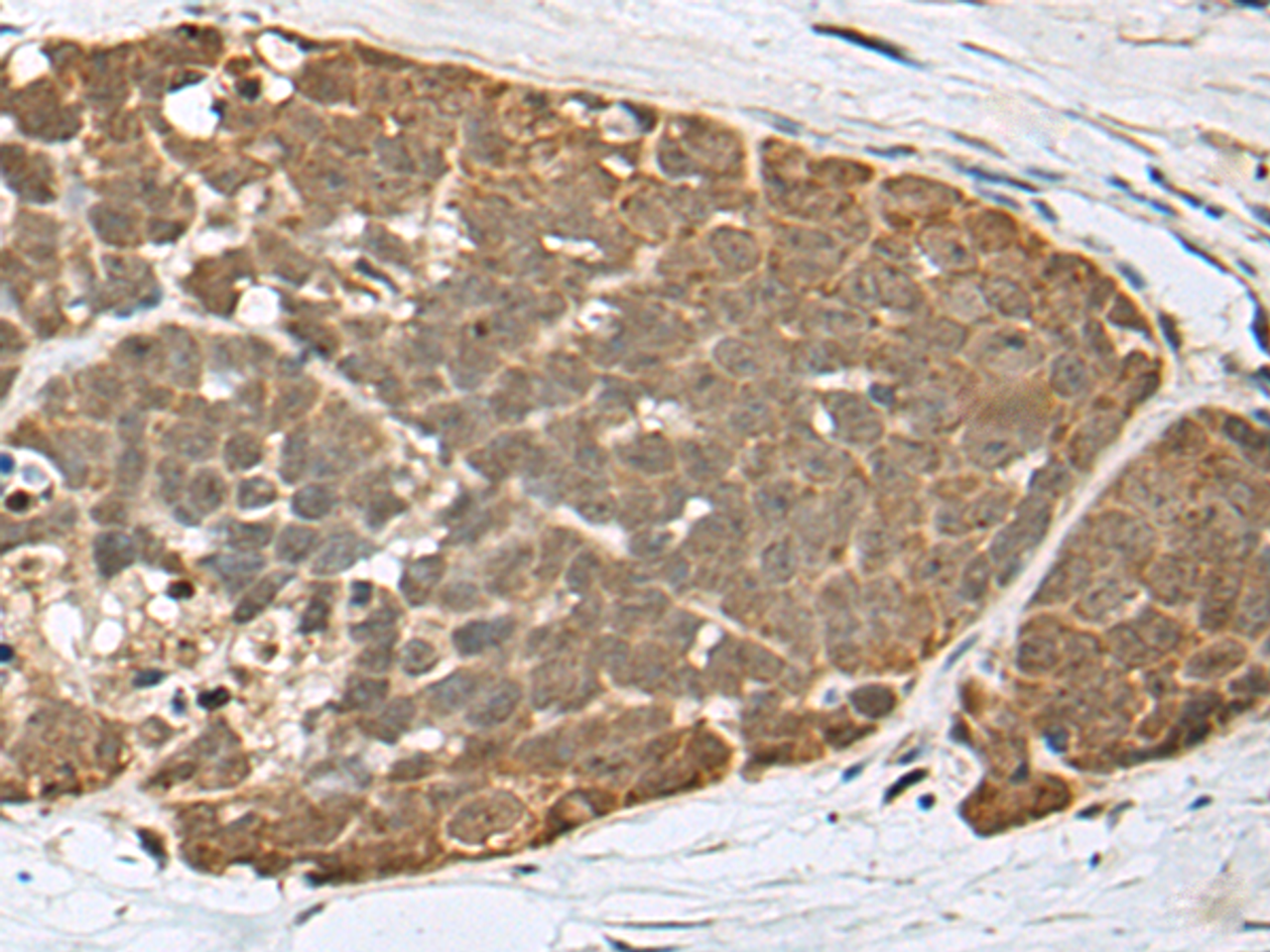 Immunohistochemistry of paraffin-embedded Human thyroid cancer tissue  using SPRTN Polyclonal Antibody at dilution of 1:65(×200)