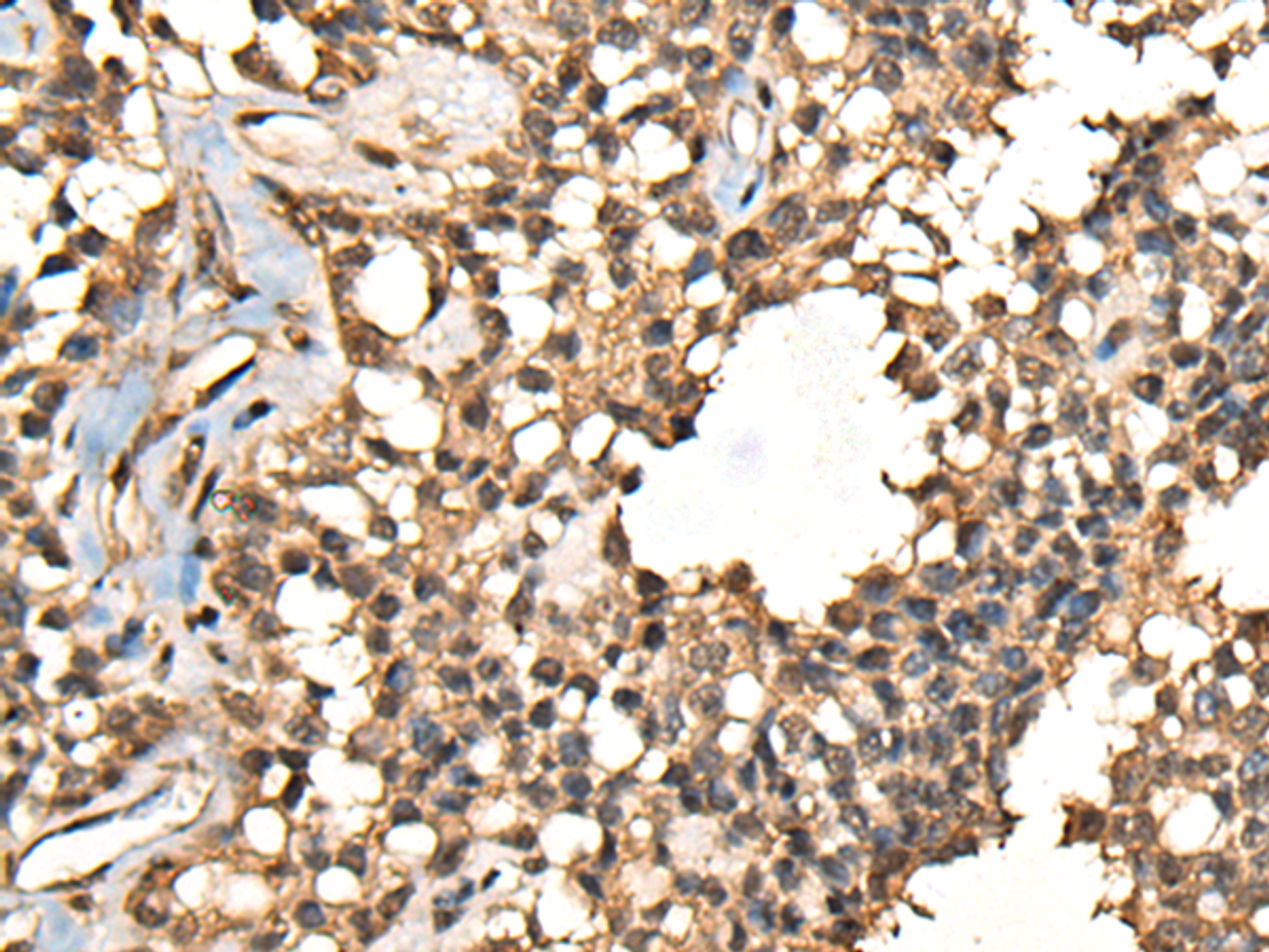 Immunohistochemistry of paraffin-embedded Human ovarian cancer tissue  using CASK Polyclonal Antibody at dilution of 1:65(×200)