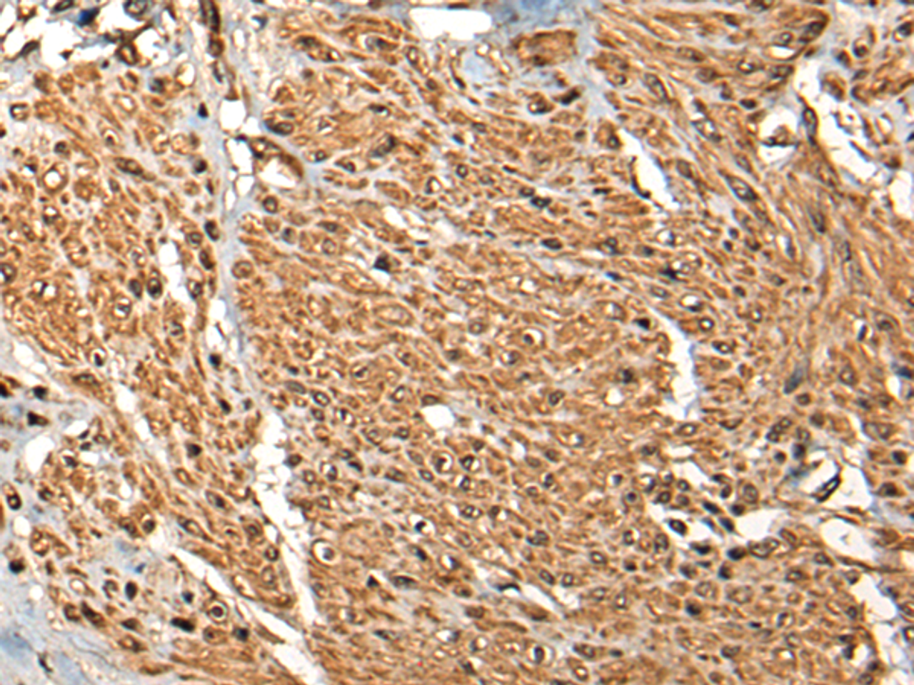 Immunohistochemistry of paraffin-embedded Human prost ate cancer tissue  using MICU1 Polyclonal Antibody at dilution of 1:35(×200)