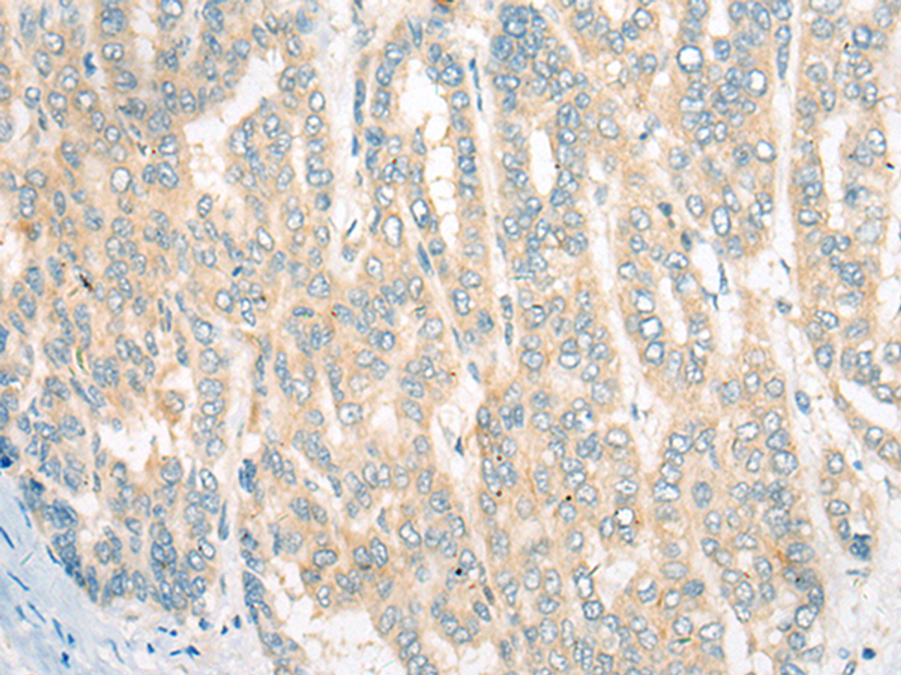 Immunohistochemistry of paraffin-embedded Human liver cancer tissue  using CDKAL1 Polyclonal Antibody at dilution of 1:60(×200)