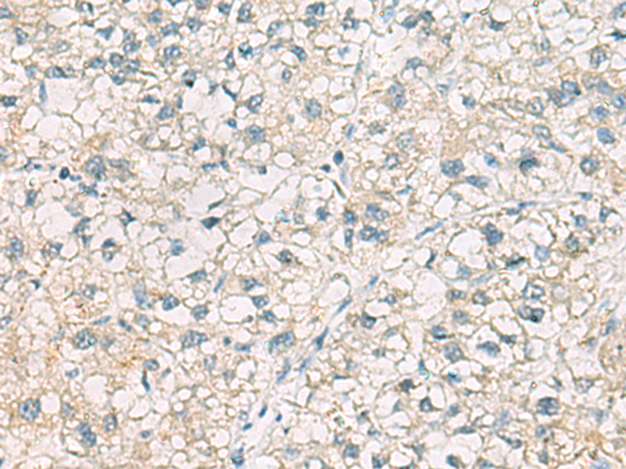 Immunohistochemistry of paraffin-embedded Human liver cancer tissue  using CHMP6 Polyclonal Antibody at dilution of 1:65(×200)
