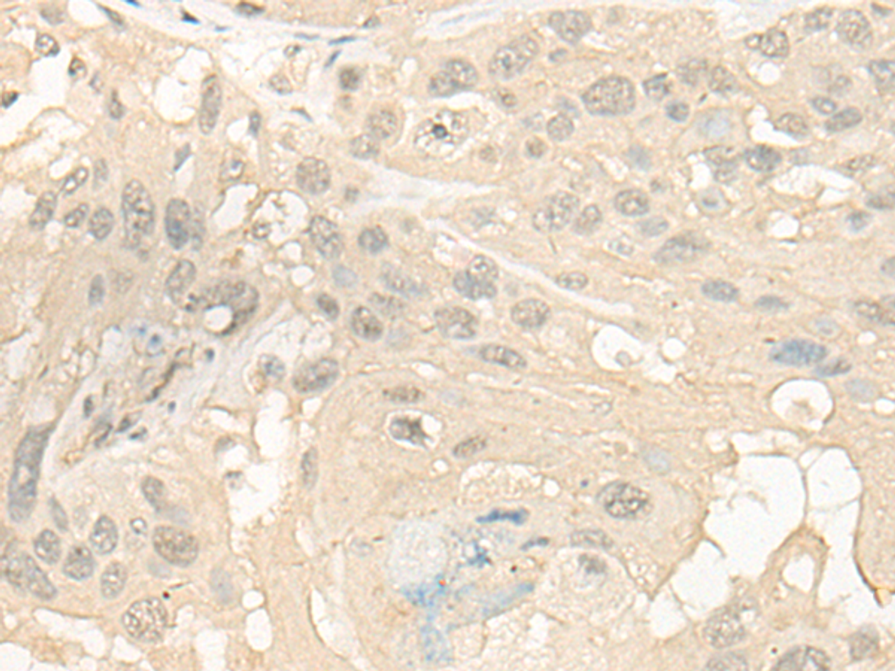 Immunohistochemistry of paraffin-embedded Human esophagus cancer tissue  using CYP4X1 Polyclonal Antibody at dilution of 1:40(×200)
