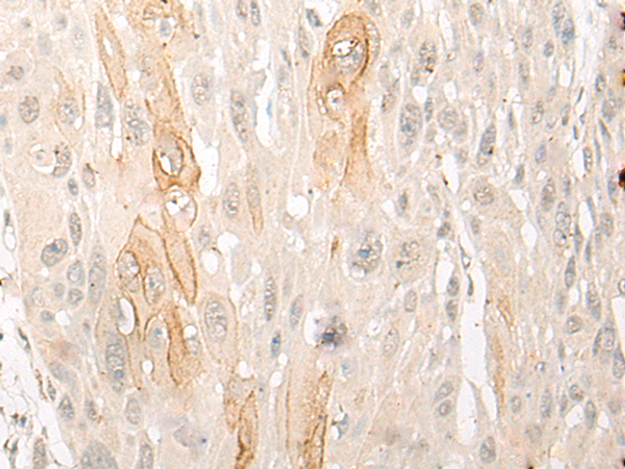 Immunohistochemistry of paraffin-embedded Human esophagus cancer tissue  using DDX24 Polyclonal Antibody at dilution of 1:35(×200)