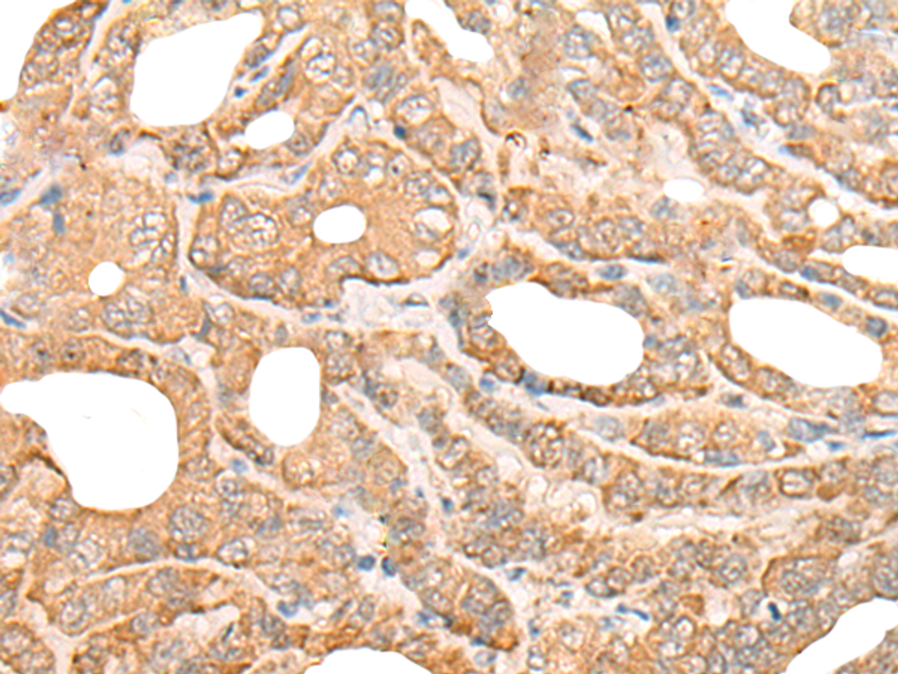 Immunohistochemistry of paraffin-embedded Human thyroid cancer tissue  using DEF8 Polyclonal Antibody at dilution of 1:25(×200)