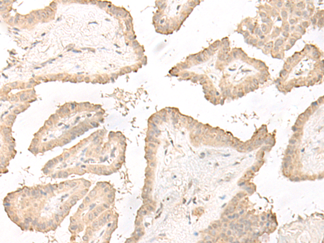 Immunohistochemistry of paraffin-embedded Human thyroid cancer tissue  using DCD Polyclonal Antibody at dilution of 1:35(×200)