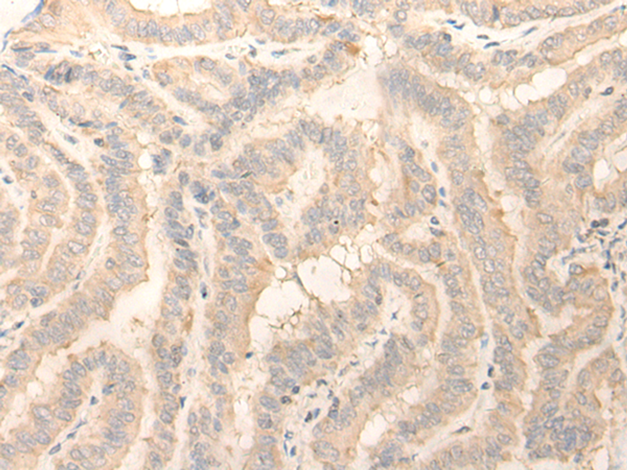 Immunohistochemistry of paraffin-embedded Human thyroid cancer tissue  using ERP27 Polyclonal Antibody at dilution of 1:25(×200)