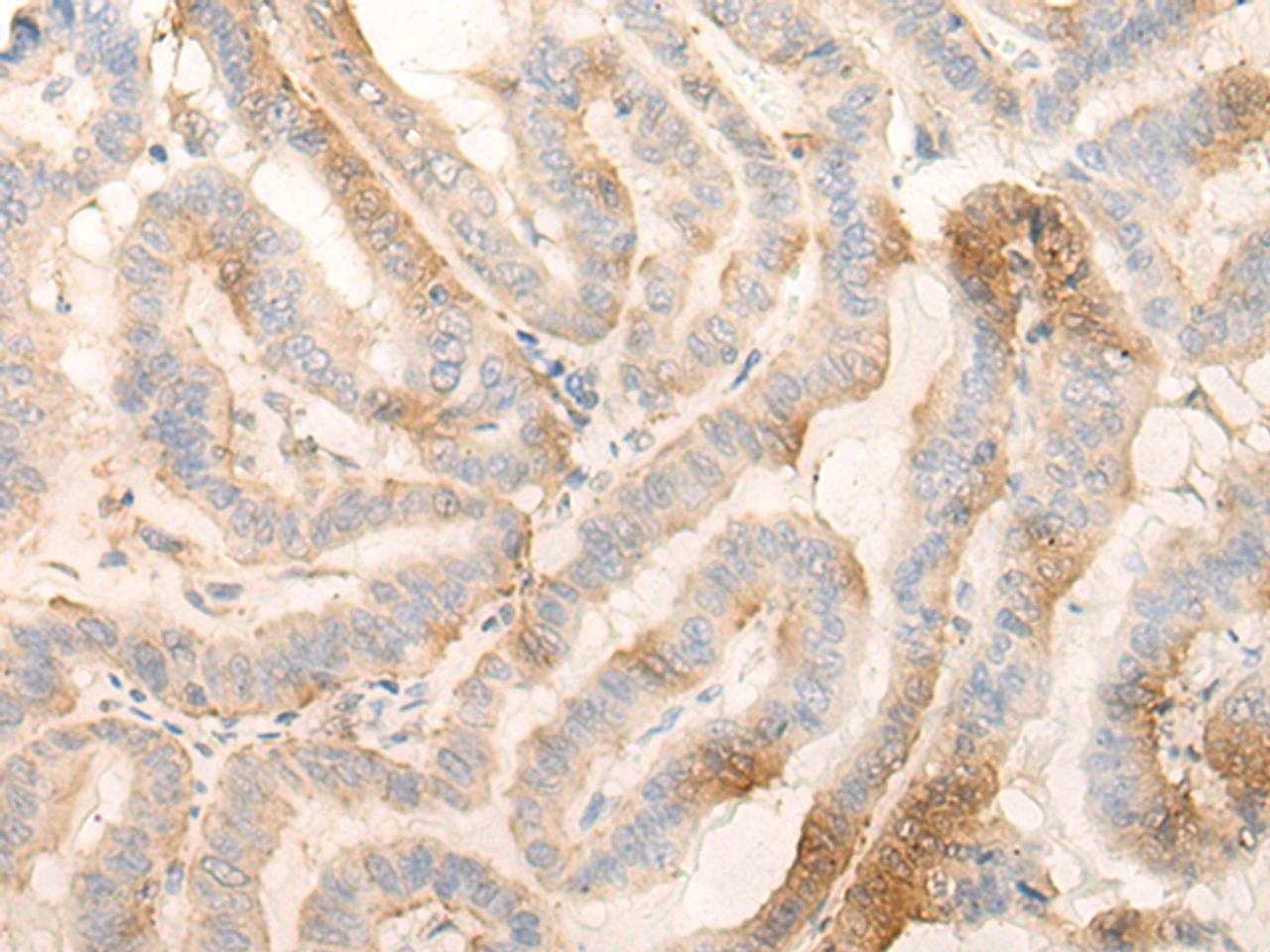 Immunohistochemistry of paraffin-embedded Human thyroid cancer tissue  using MPPED2 Polyclonal Antibody at dilution of 1:30(×200)