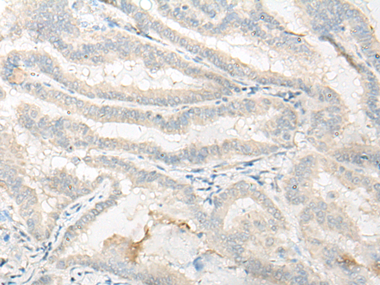 Immunohistochemistry of paraffin-embedded Human thyroid cancer tissue  using DNASE1L1 Polyclonal Antibody at dilution of 1:25(×200)