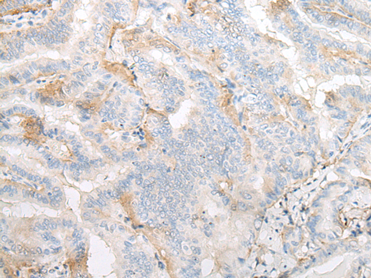 Immunohistochemistry of paraffin-embedded Human thyroid cancer tissue  using TMEM248 Polyclonal Antibody at dilution of 1:25(×200)