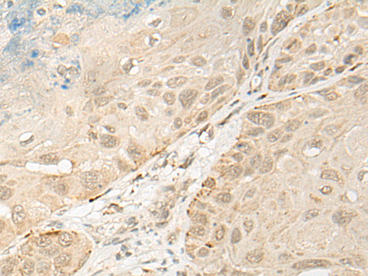 Immunohistochemistry of paraffin-embedded Human esophagus cancer tissue  using OTX1 Polyclonal Antibody at dilution of 1:30(×200)