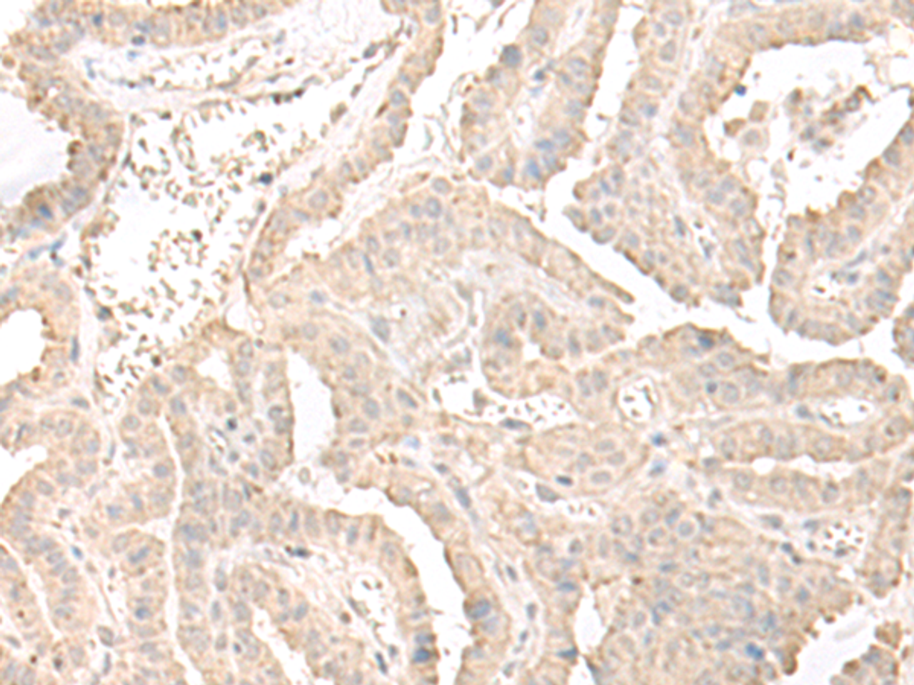 Immunohistochemistry of paraffin-embedded Human thyroid cancer tissue  using ERGIC3 Polyclonal Antibody at dilution of 1:50(×200)