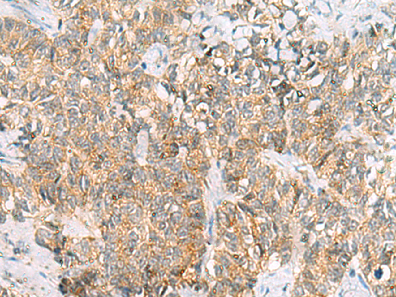 Immunohistochemistry of paraffin-embedded Human ovarian cancer tissue  using TUFT1 Polyclonal Antibody at dilution of 1:120(×200)