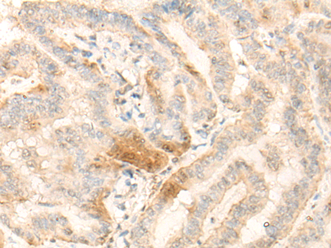 Immunohistochemistry of paraffin-embedded Human thyroid cancer tissue  using BZW2 Polyclonal Antibody at dilution of 1:25(×200)