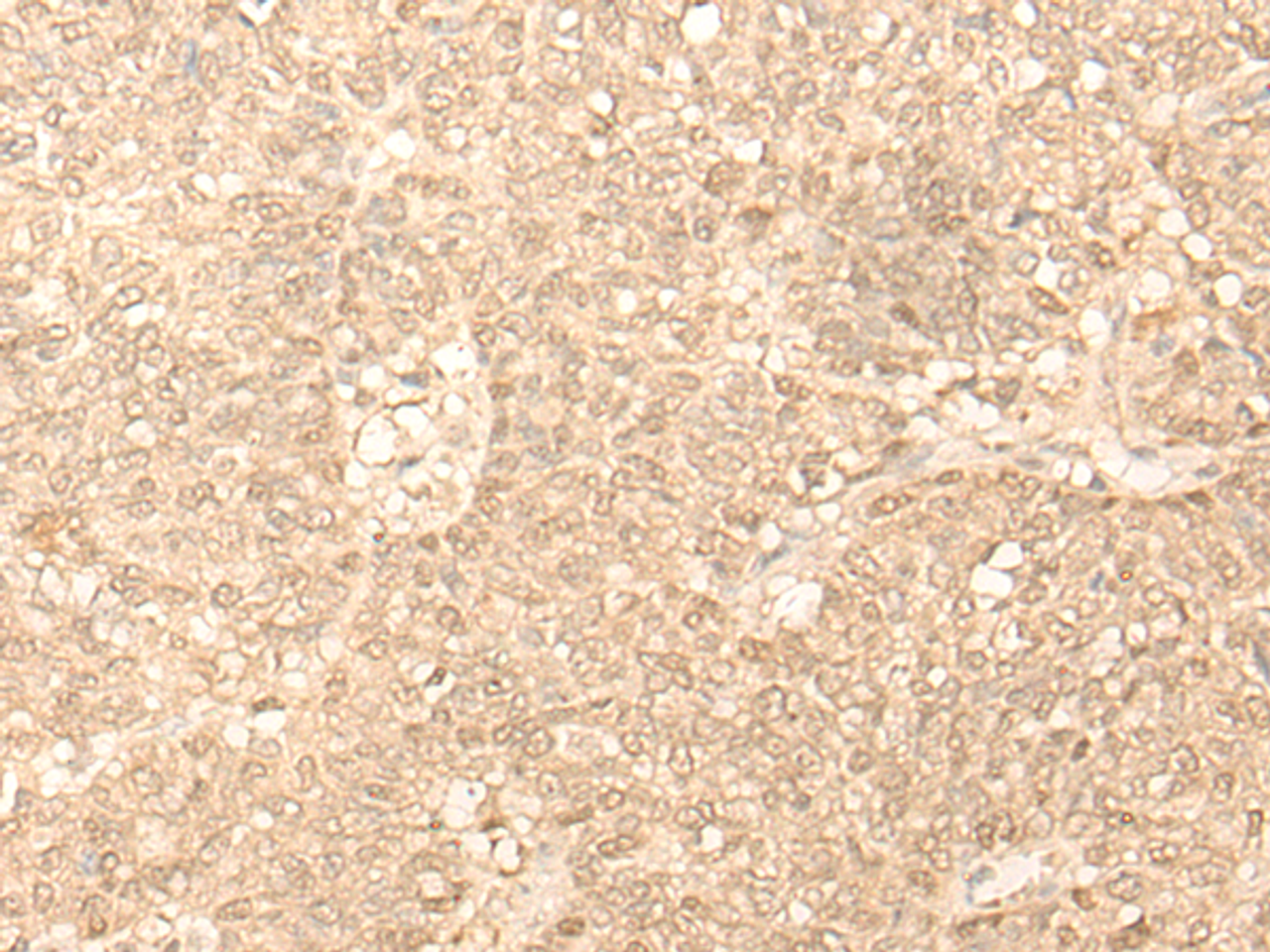 Immunohistochemistry of paraffin-embedded Human ovarian cancer tissue  using FAH Polyclonal Antibody at dilution of 1:40(×200)