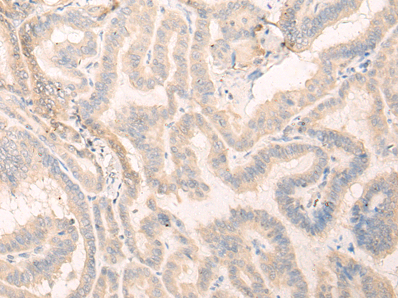 Immunohistochemistry of paraffin-embedded Human thyroid cancer tissue  using SEPT10 Polyclonal Antibody at dilution of 1:25(×200)