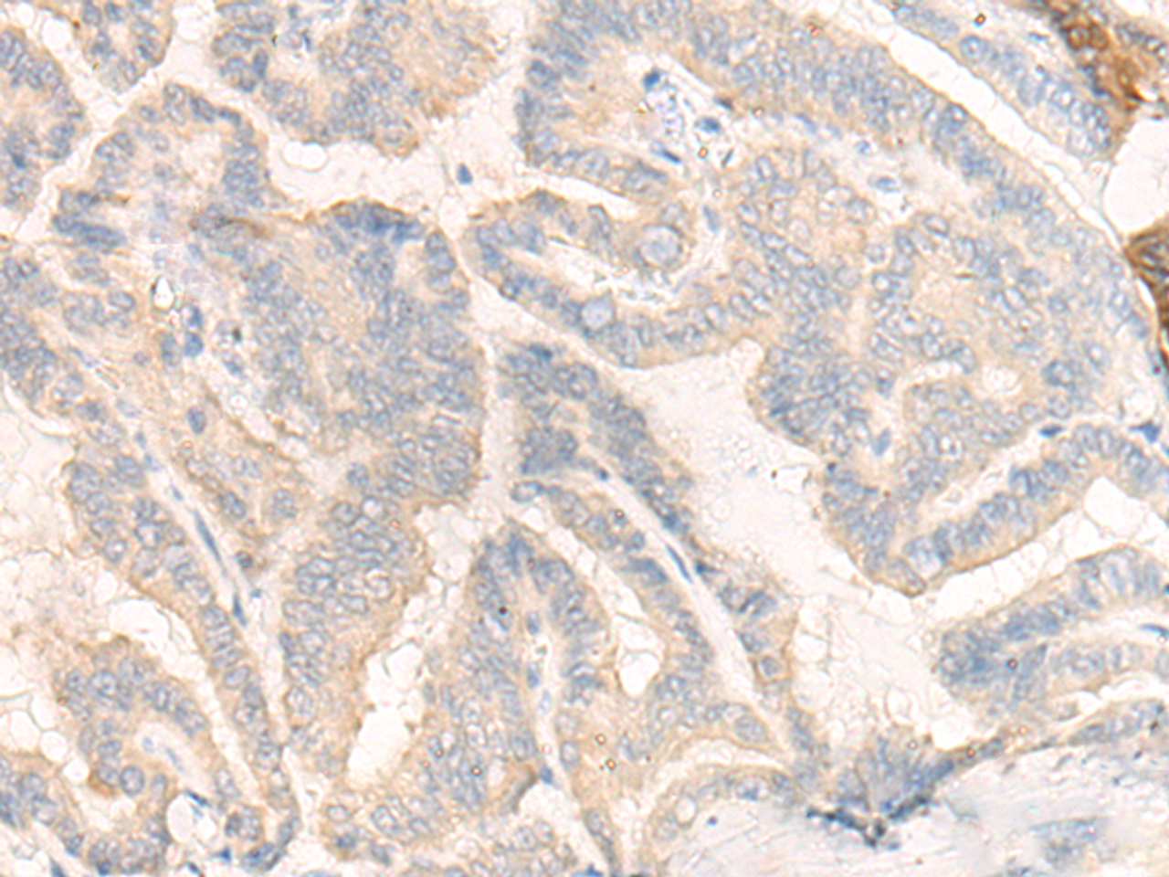 Immunohistochemistry of paraffin-embedded Human thyroid cancer tissue  using COG4 Polyclonal Antibody at dilution of 1:30(×200)
