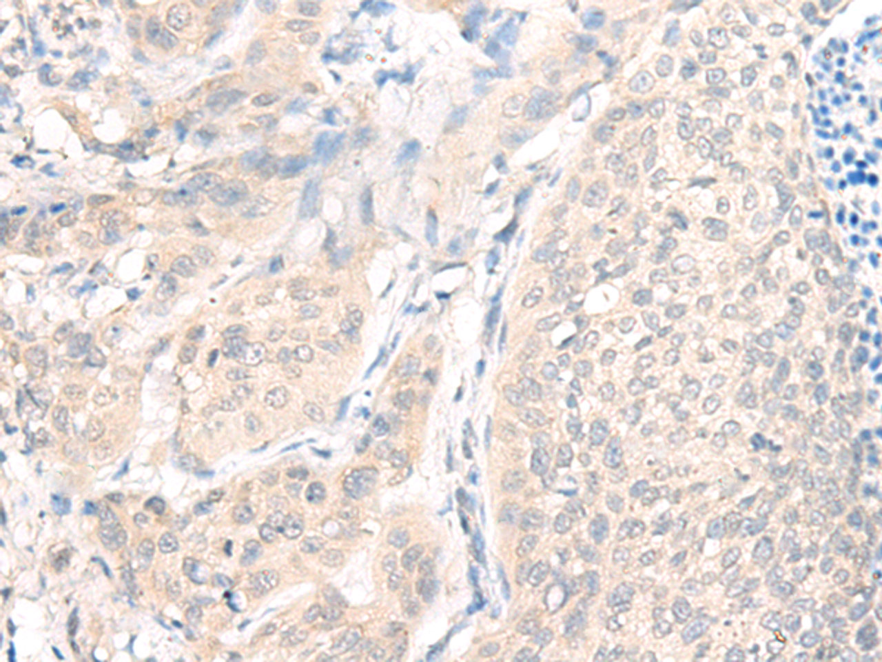 Immunohistochemistry of paraffin-embedded Human cervical cancer tissue  using AOAH Polyclonal Antibody at dilution of 1:25(×200)