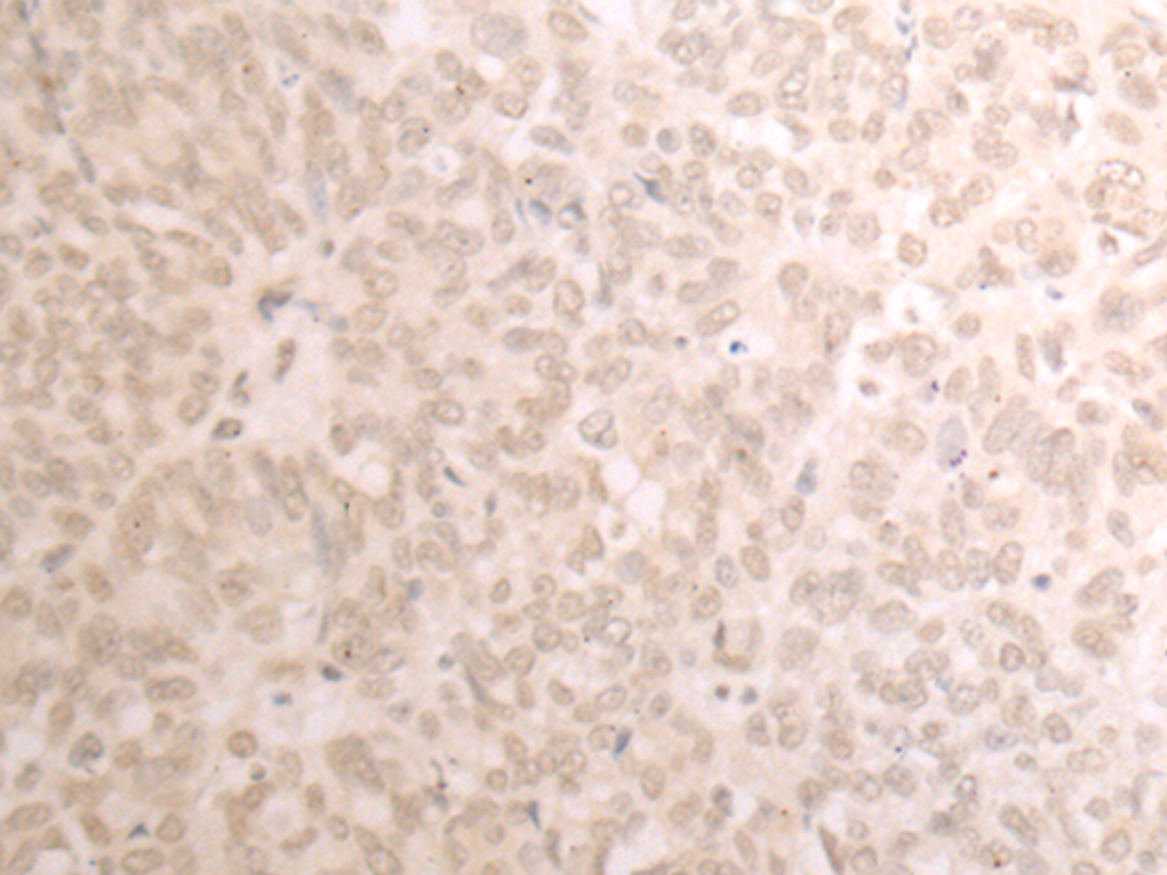 Immunohistochemistry of paraffin-embedded Human ovarian cancer tissue  using TRMT1 Polyclonal Antibody at dilution of 1:25(×200)