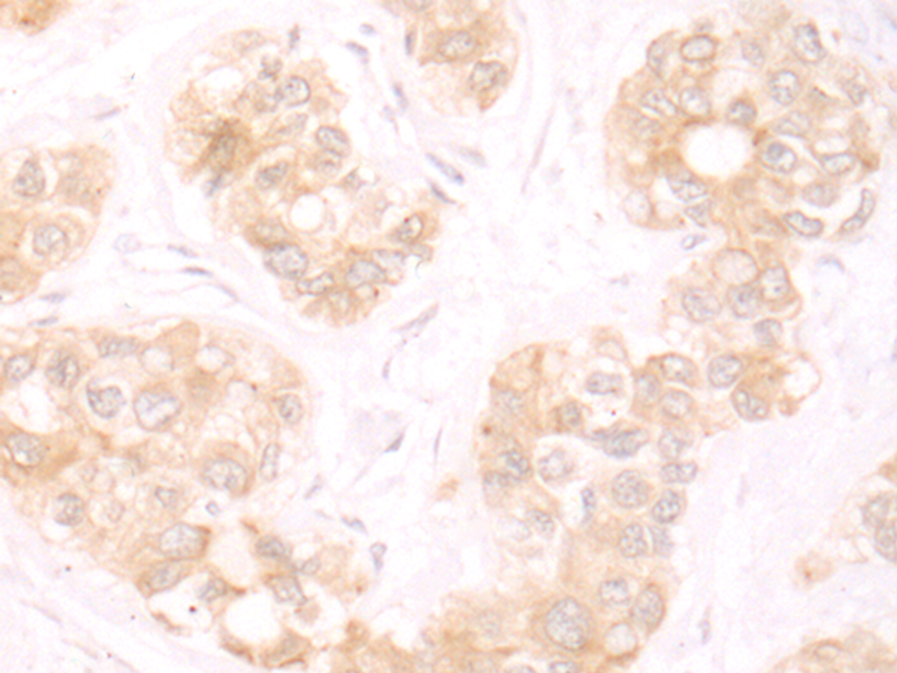 Immunohistochemistry of paraffin-embedded Human liver cancer tissue  using TRMT1 Polyclonal Antibody at dilution of 1:25(×200)