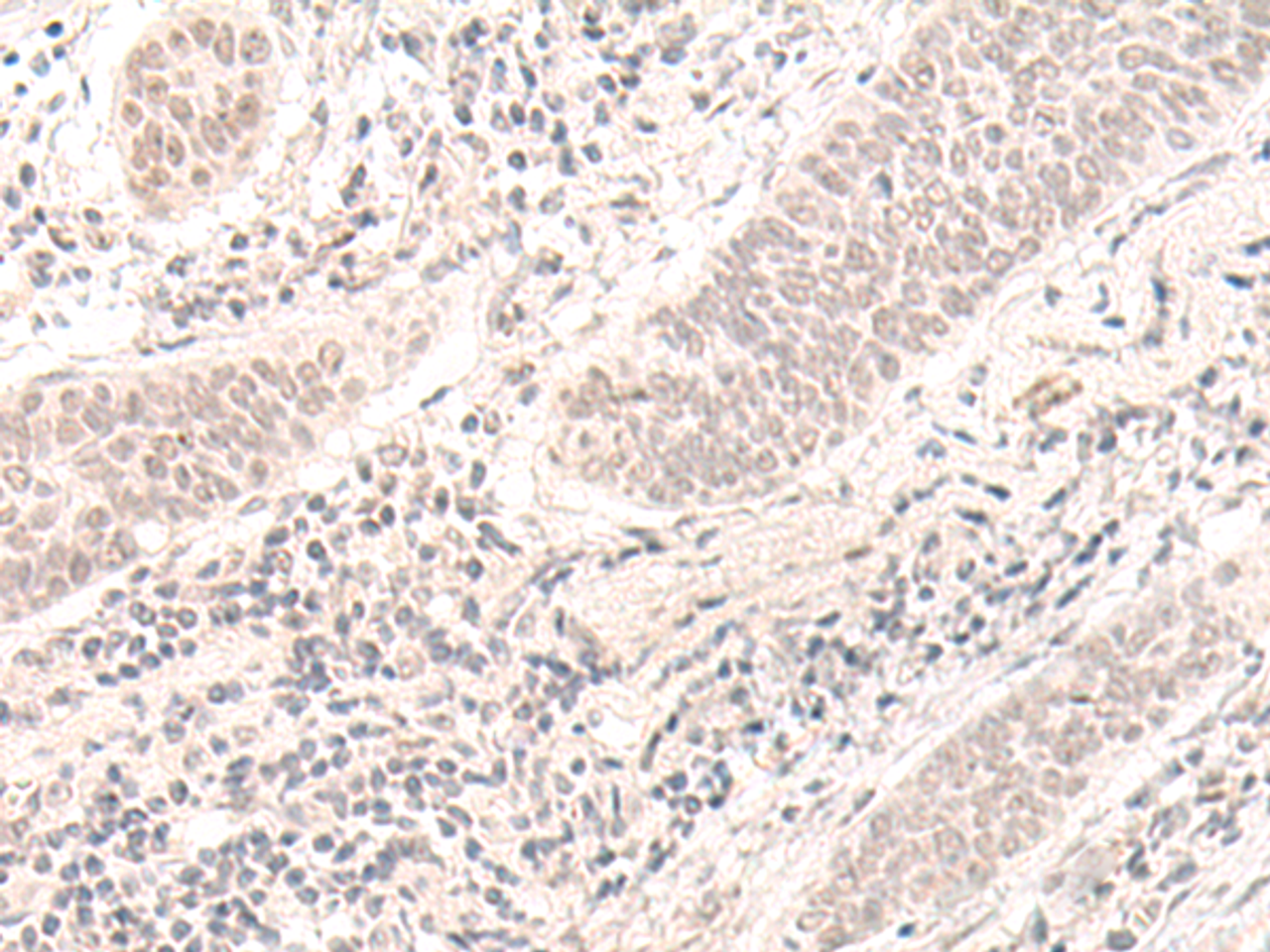 Immunohistochemistry of paraffin-embedded Human esophagus cancer tissue  using ZBED1 Polyclonal Antibody at dilution of 1:40(×200)