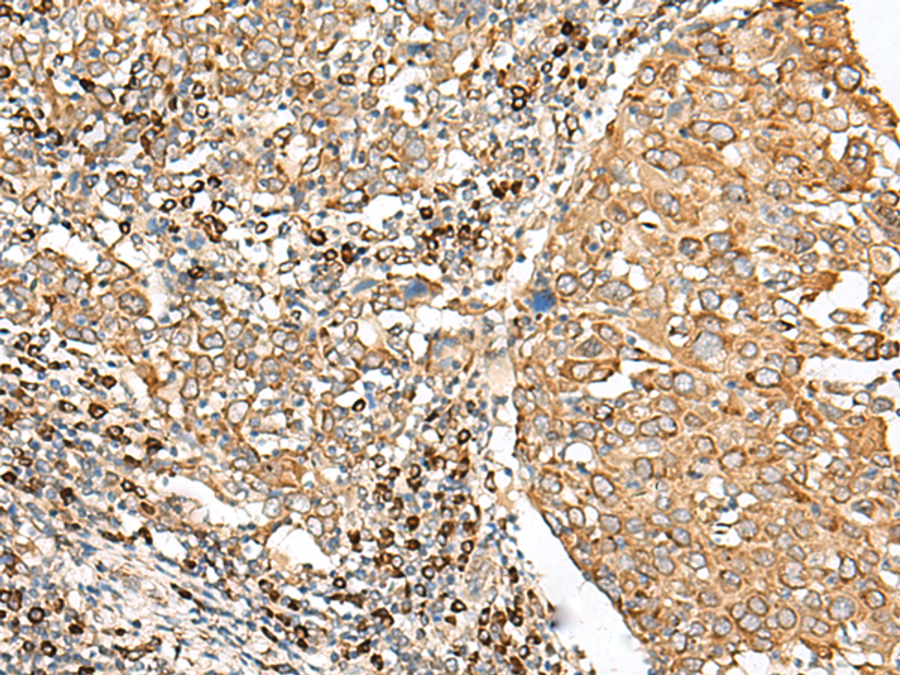 Immunohistochemistry of paraffin-embedded Human cervical cancer tissue  using STT3A Polyclonal Antibody at dilution of 1:70(×200)