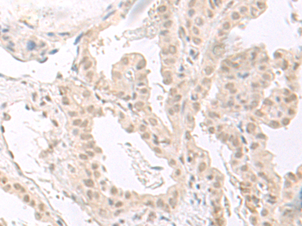 Immunohistochemistry of paraffin-embedded Human thyroid cancer tissue  using HOOK2 Polyclonal Antibody at dilution of 1:30(×200)