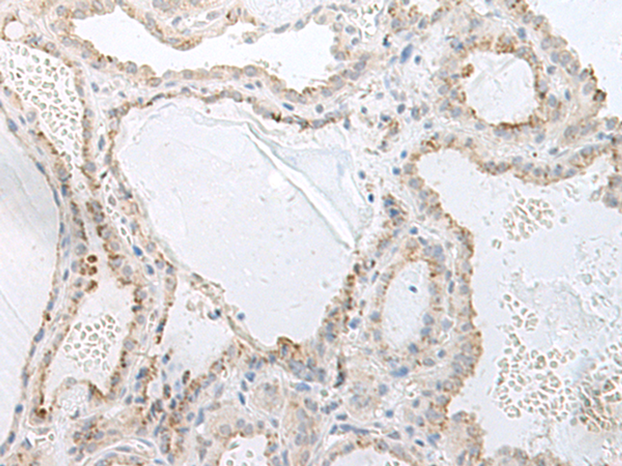 Immunohistochemistry of paraffin-embedded Human thyroid cancer tissue  using GPRASP2 Polyclonal Antibody at dilution of 1:75(×200)