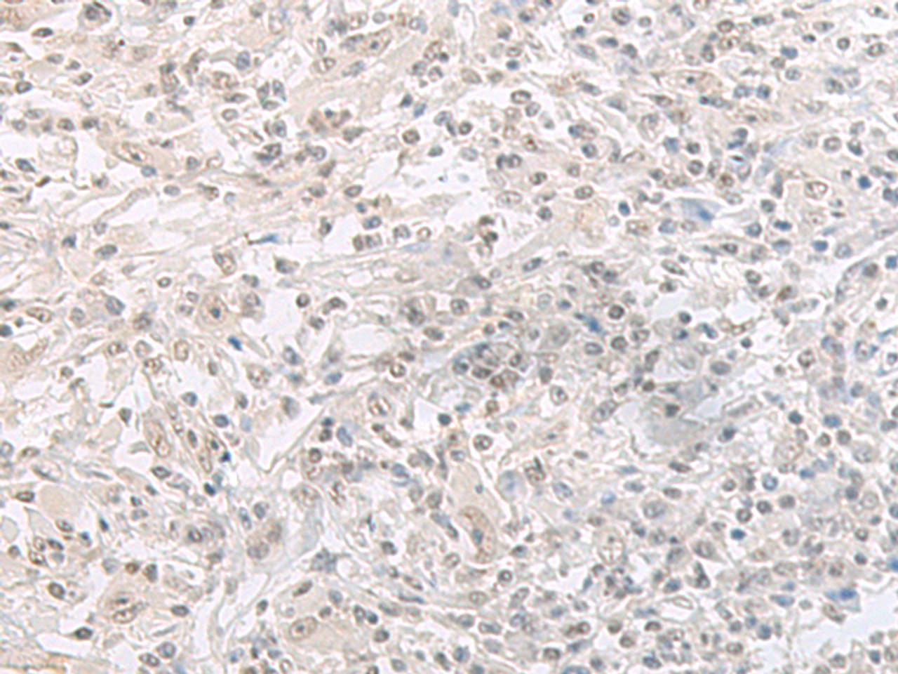 Immunohistochemistry of paraffin-embedded Human liver cancer tissue  using ORC1 Polyclonal Antibody at dilution of 1:65(×200)