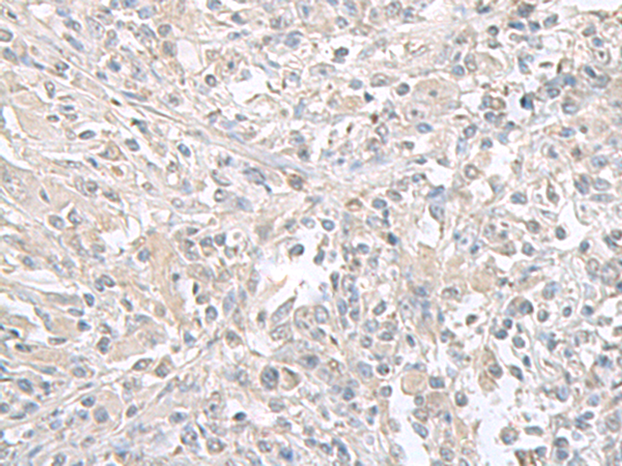 Immunohistochemistry of paraffin-embedded Human liver cancer tissue  using FXYD6 Polyclonal Antibody at dilution of 1:65(×200)