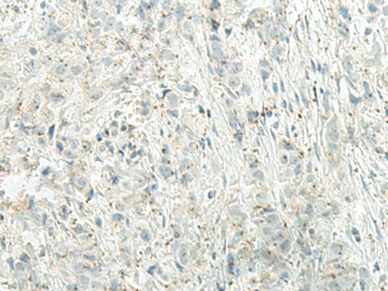 Immunohistochemistry of paraffin-embedded Human breast cancer tissue  using UQCC2 Polyclonal Antibody at dilution of 1:60(×200)