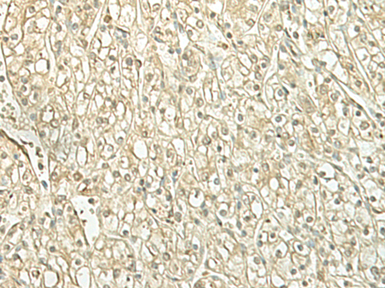 Immunohistochemistry of paraffin-embedded Human kidney cancer tissue  using SPIRE1 Polyclonal Antibody at dilution of 1:60(×200)