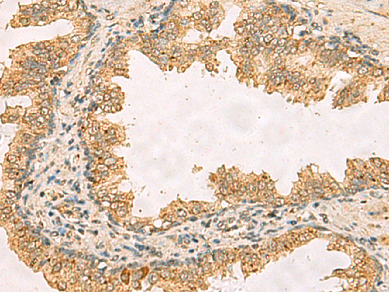 Immunohistochemistry of paraffin-embedded Human prost ate cancer tissue  using RPS11 Polyclonal Antibody at dilution of 1:40(×200)