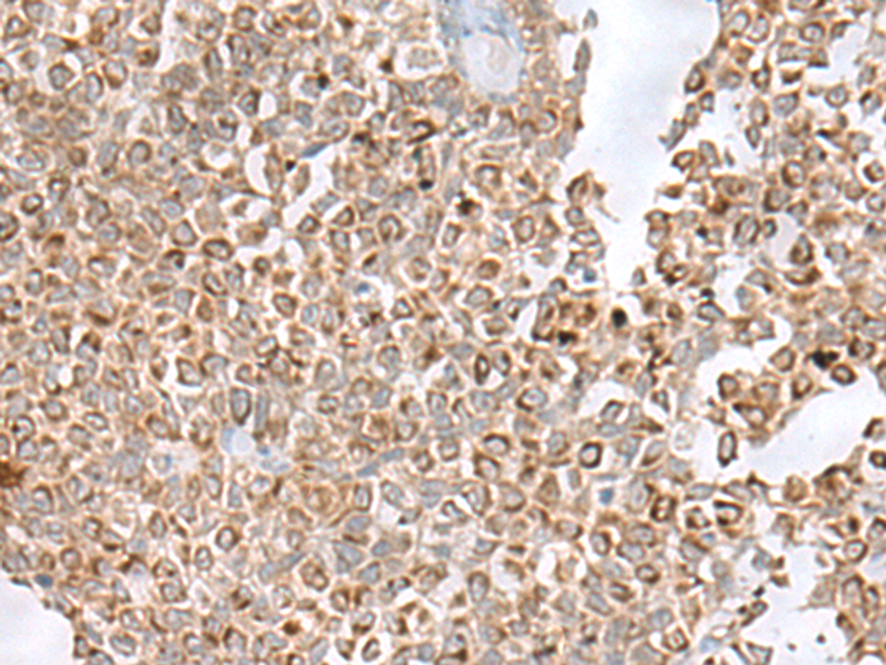 Immunohistochemistry of paraffin-embedded Human ovarian cancer tissue  using GLYAT Polyclonal Antibody at dilution of 1:50(×200)