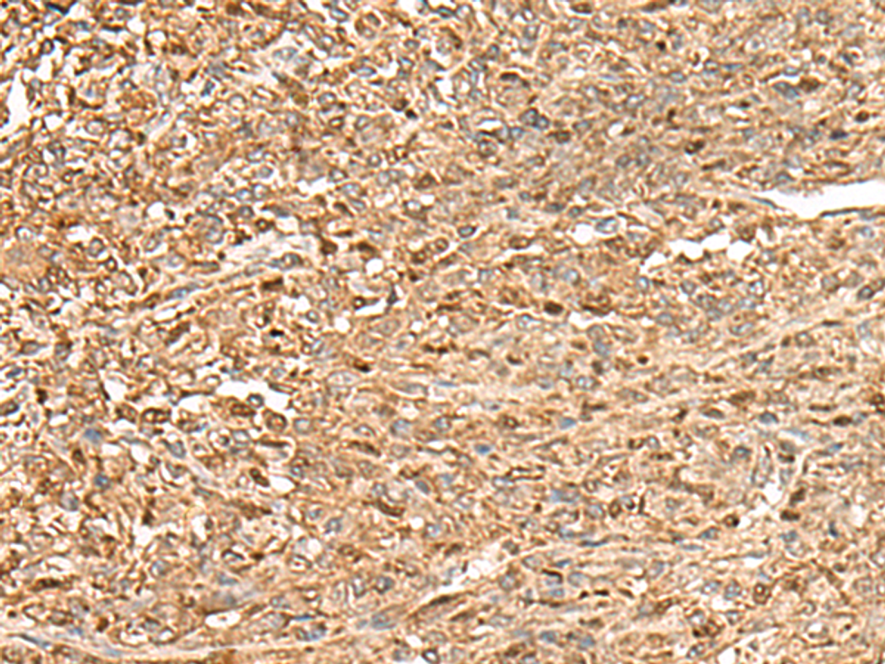 Immunohistochemistry of paraffin-embedded Human liver cancer tissue  using ZC3H7A Polyclonal Antibody at dilution of 1:50(×200)