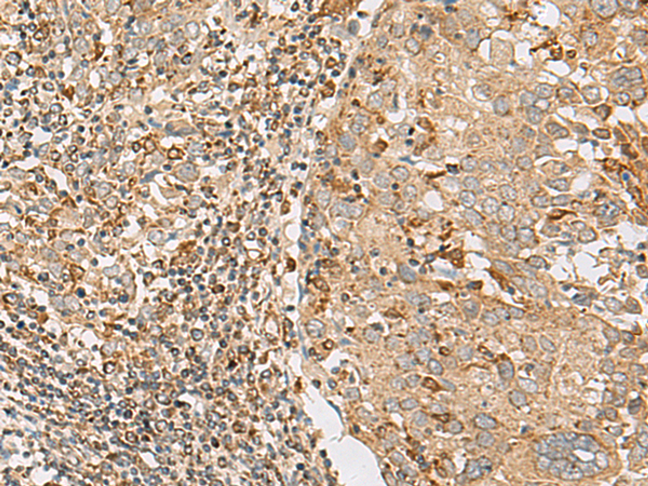 Immunohistochemistry of paraffin-embedded Human cervical cancer tissue  using ZC3H7A Polyclonal Antibody at dilution of 1:50(×200)