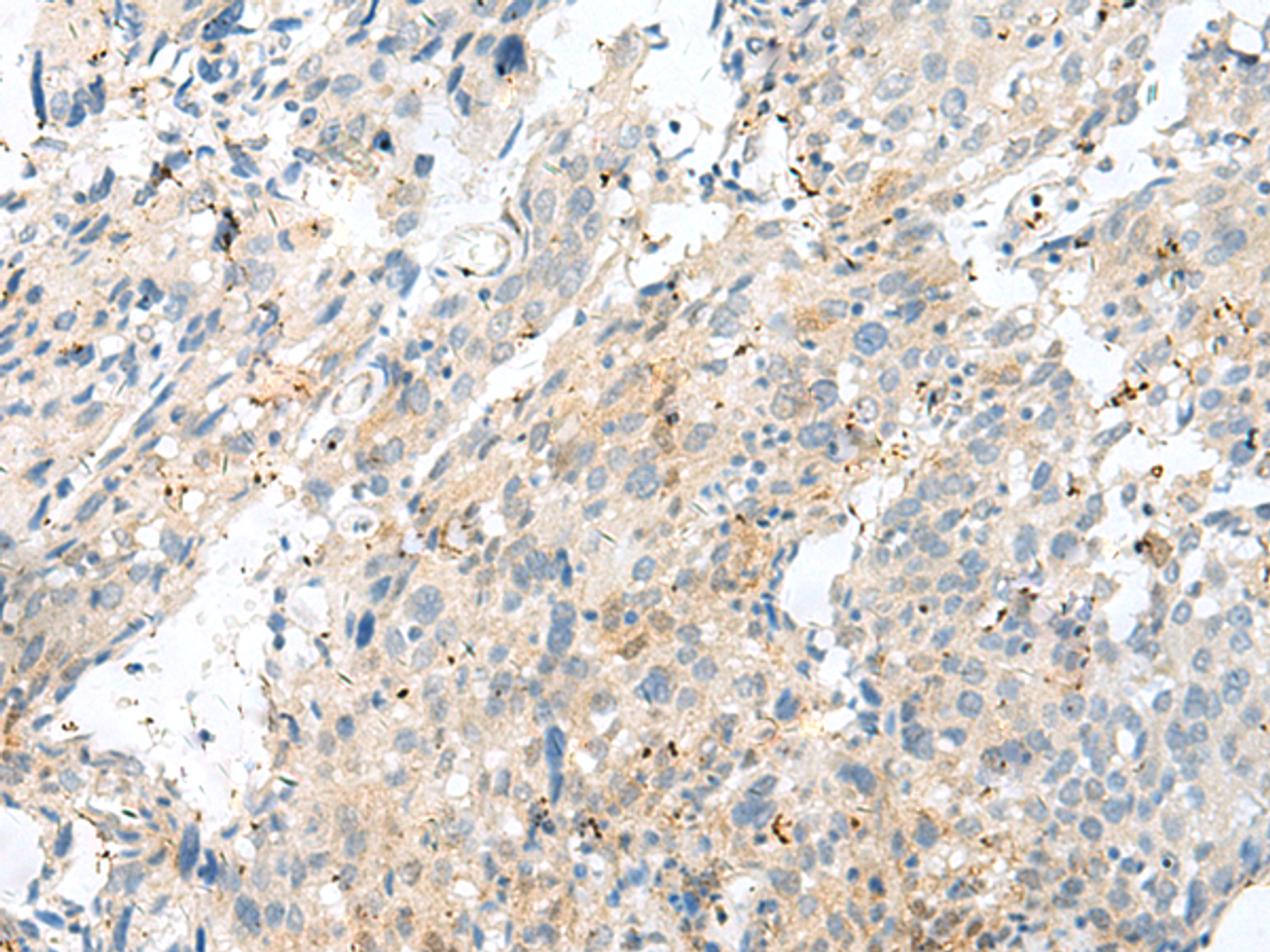 Immunohistochemistry of paraffin-embedded Human cervical cancer tissue  using NXNL1 Polyclonal Antibody at dilution of 1:45(×200)