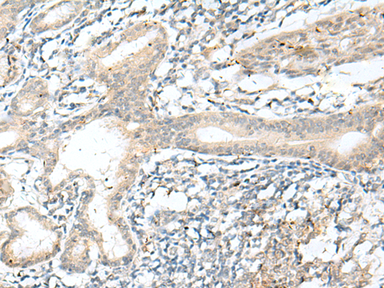 Immunohistochemistry of paraffin-embedded Human esophagus cancer tissue  using NXNL1 Polyclonal Antibody at dilution of 1:45(×200)