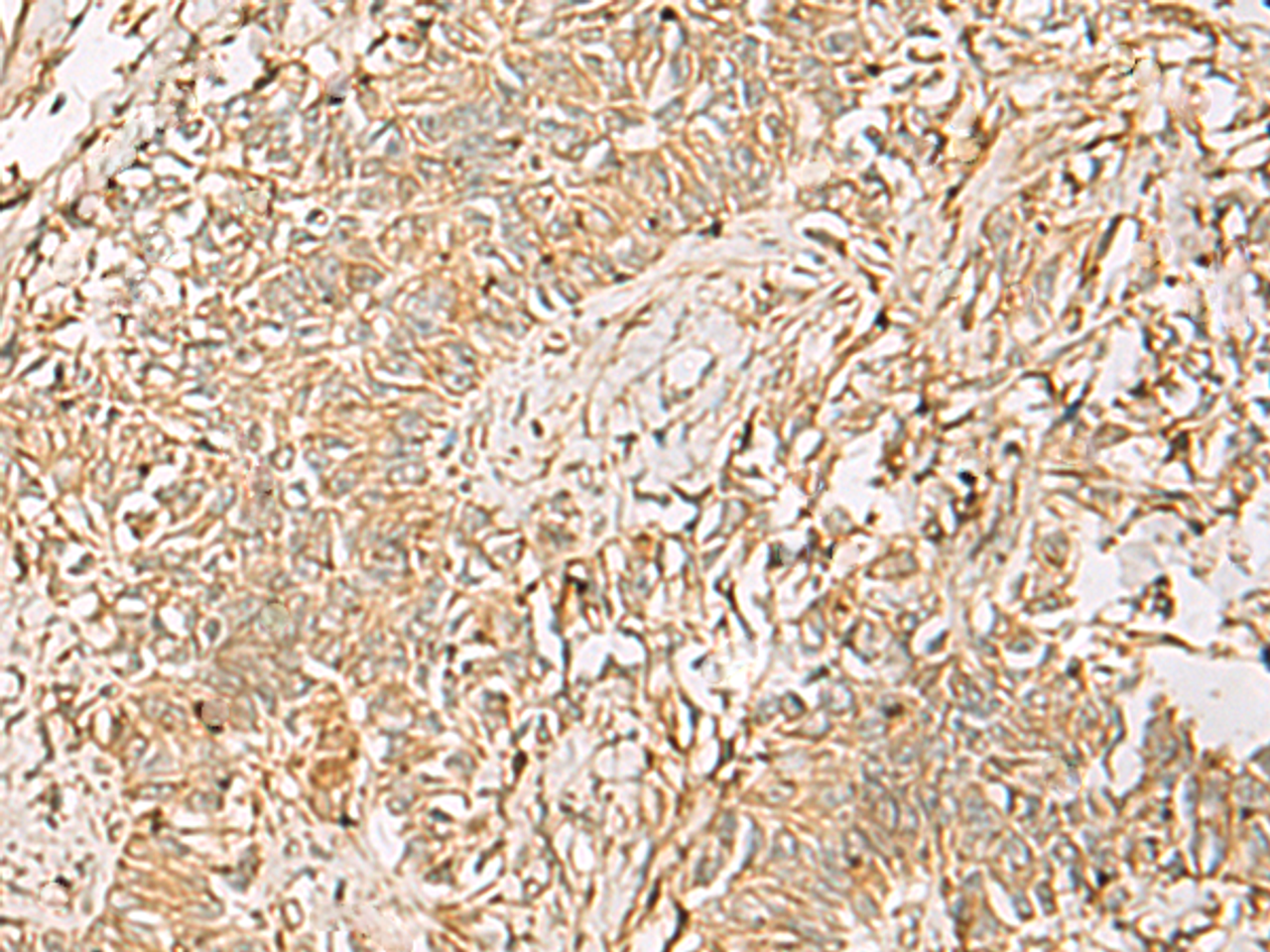 Immunohistochemistry of paraffin-embedded Human ovarian cancer tissue  using QDPR Polyclonal Antibody at dilution of 1:70(×200)