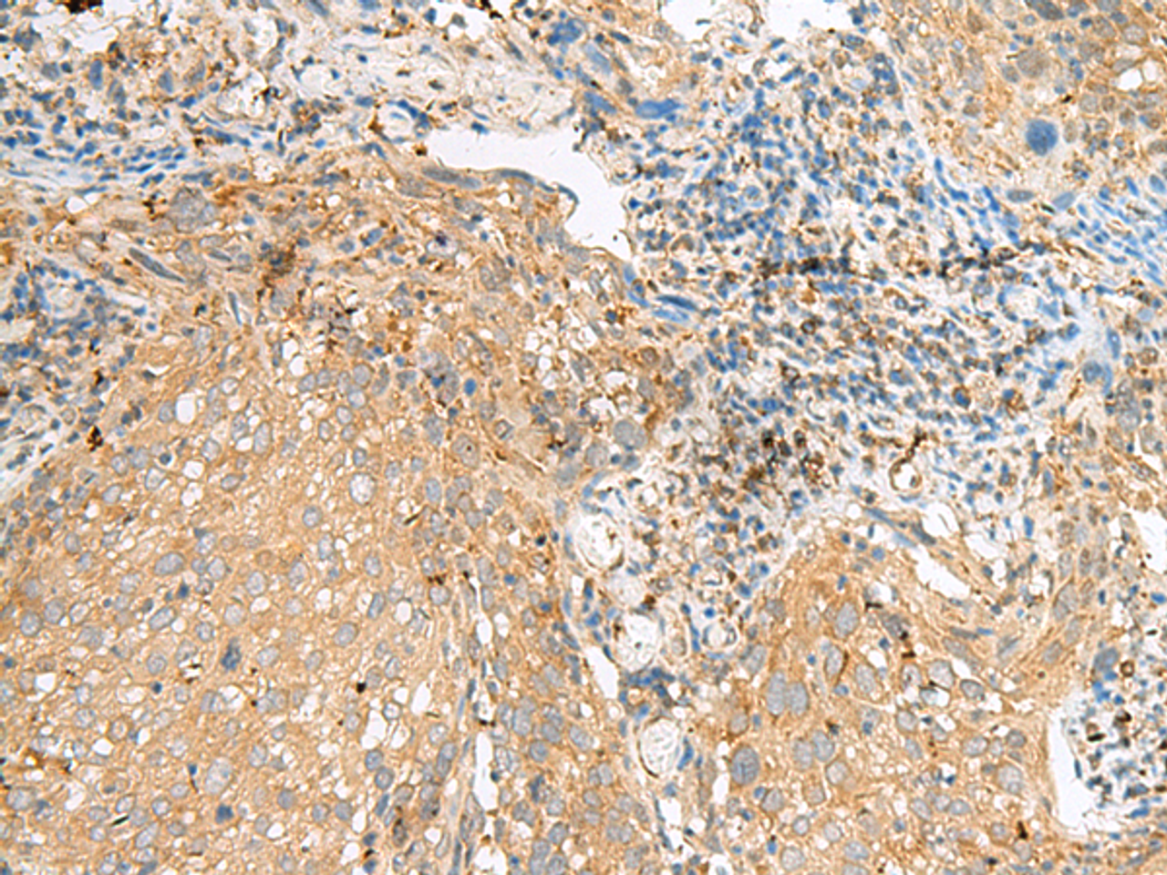 Immunohistochemistry of paraffin-embedded Human cervical cancer tissue  using COPE Polyclonal Antibody at dilution of 1:50(×200)