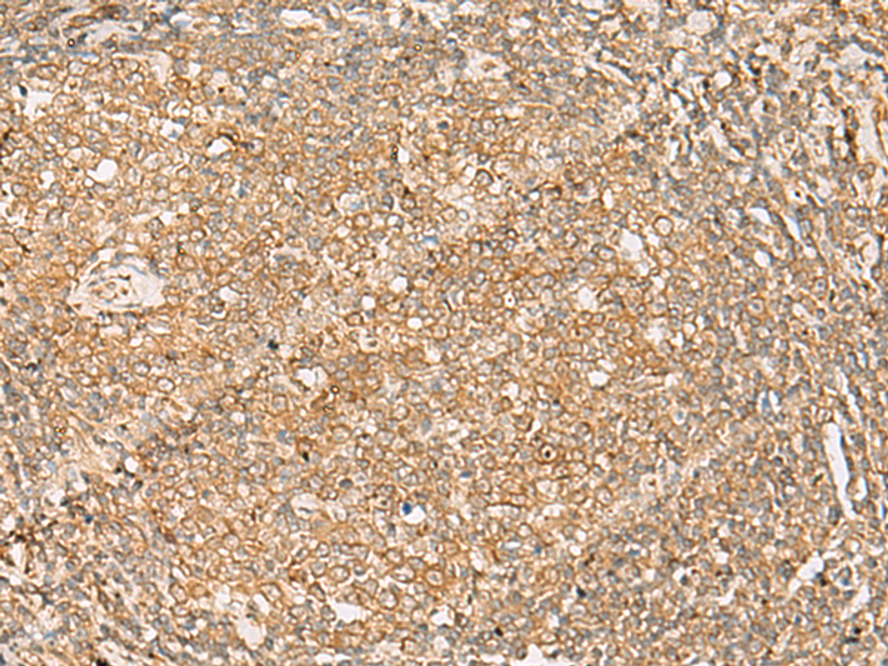 Immunohistochemistry of paraffin-embedded Human tonsil tissue  using FNTB Polyclonal Antibody at dilution of 1:35(×200)