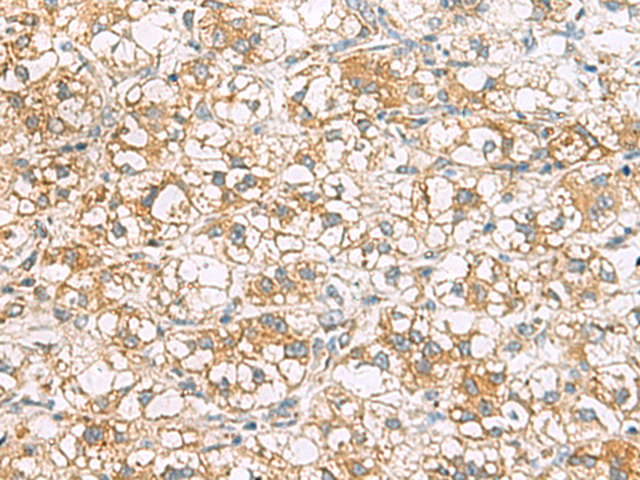 Immunohistochemistry of paraffin-embedded Human liver cancer tissue  using TLE6 Polyclonal Antibody at dilution of 1:75(×200)