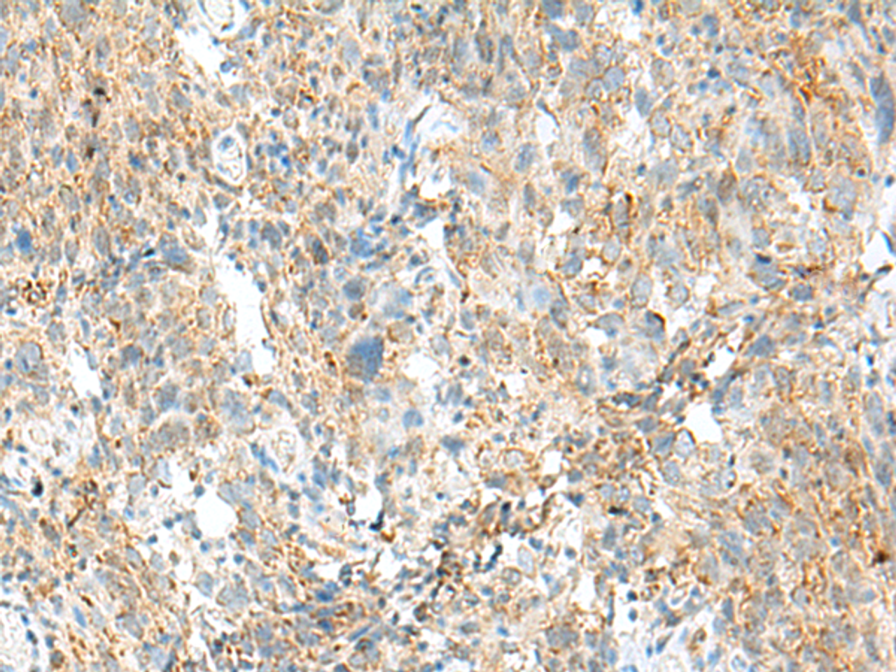 Immunohistochemistry of paraffin-embedded Human cervical cancer tissue  using MCCC1 Polyclonal Antibody at dilution of 1:45(×200)