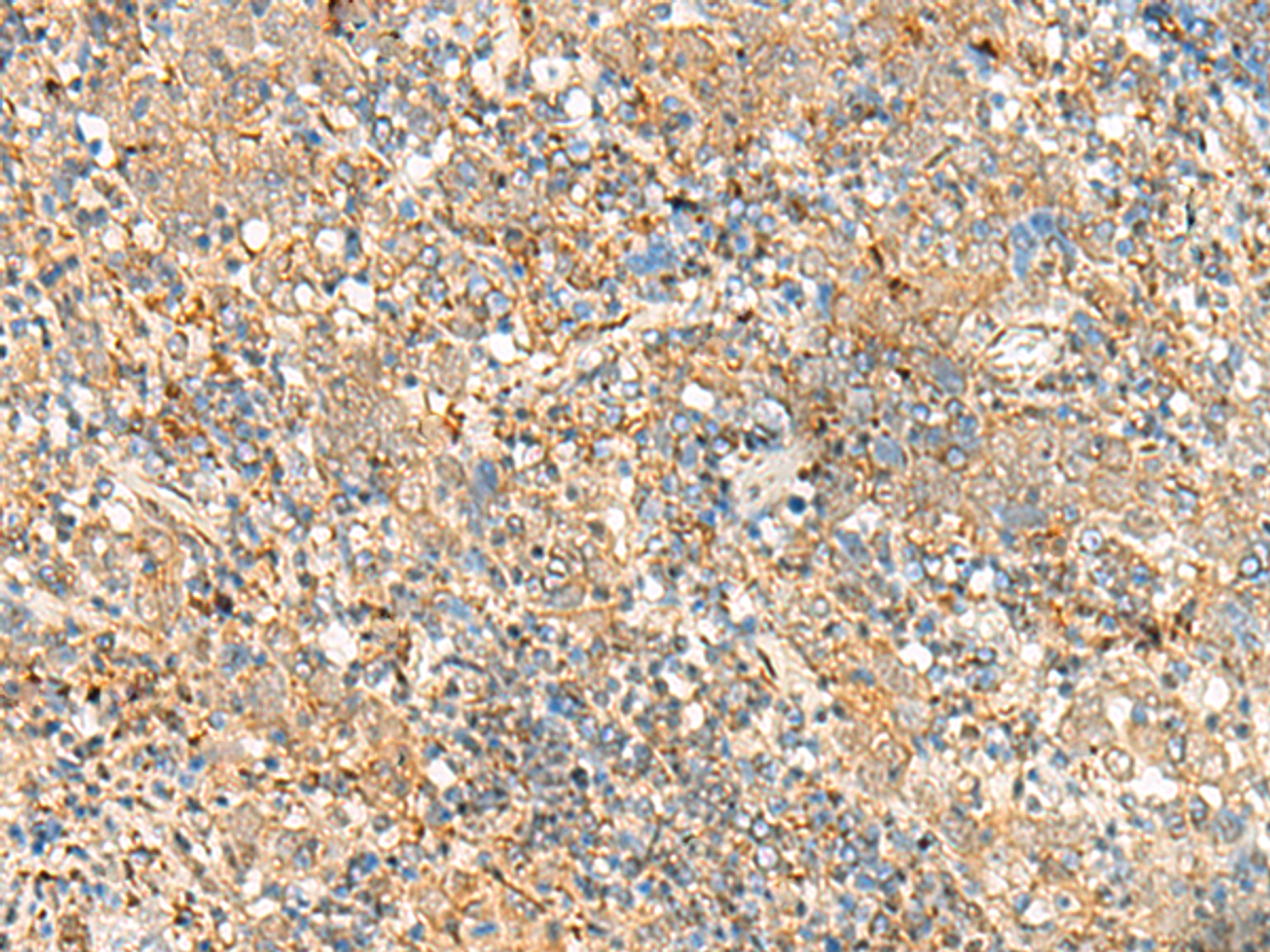 Immunohistochemistry of paraffin-embedded Human cervical cancer tissue  using FKBP1A Polyclonal Antibody at dilution of 1:55(×200)