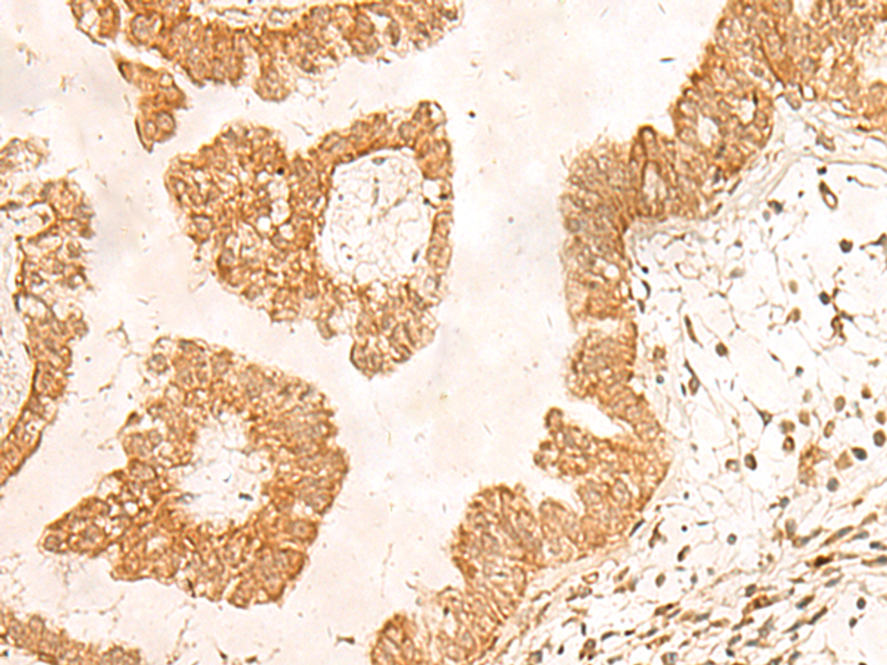 Immunohistochemistry of paraffin-embedded Human liver cancer tissue  using POLR1D Polyclonal Antibody at dilution of 1:50(×200)