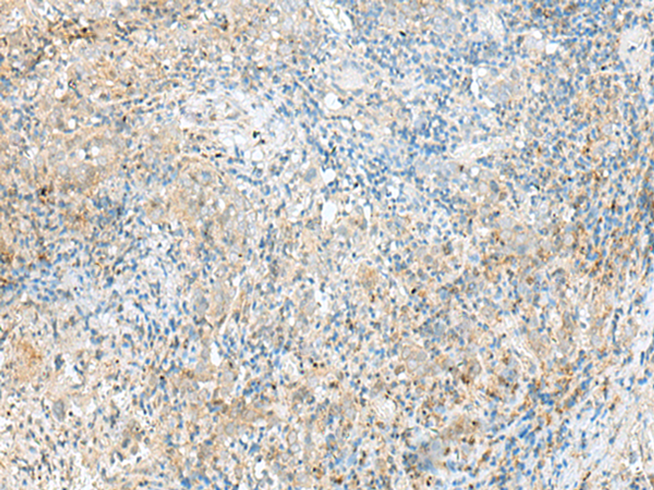 Immunohistochemistry of paraffin-embedded Human cervical cancer tissue  using RPP14 Polyclonal Antibody at dilution of 1:60(×200)