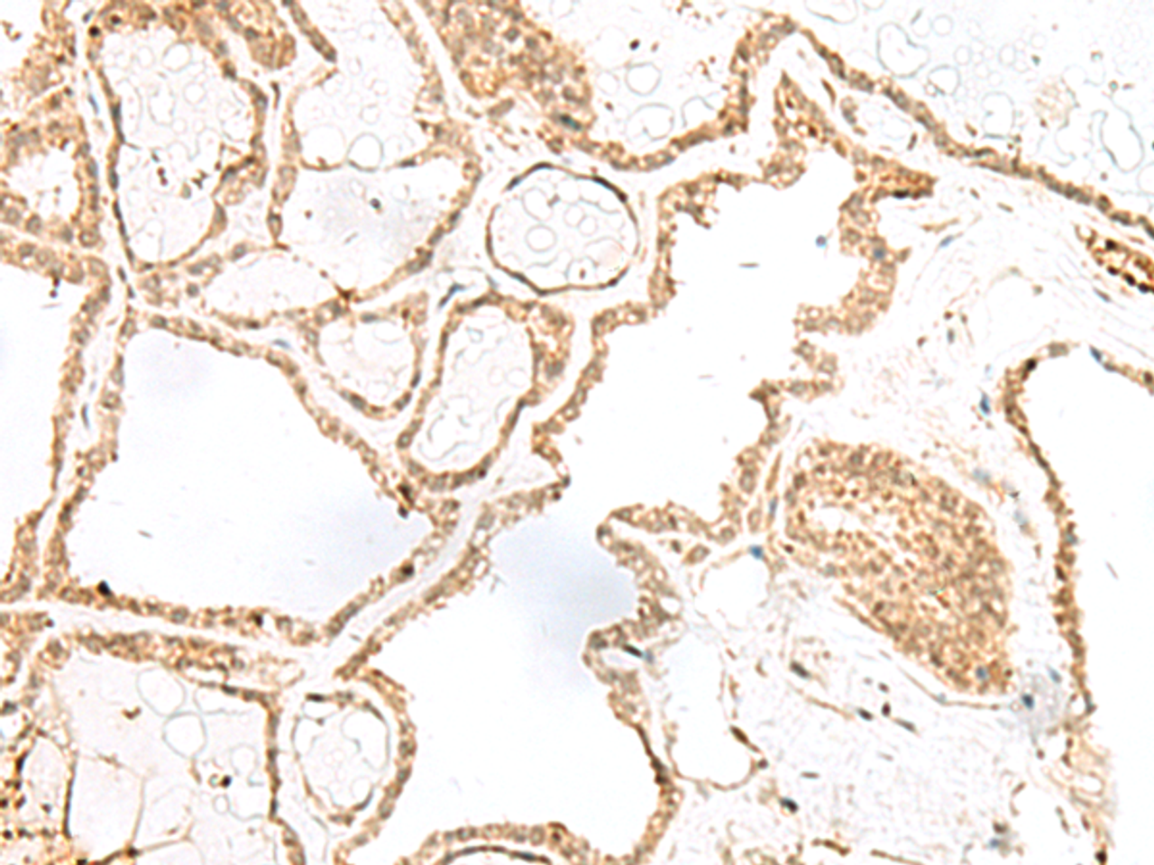 Immunohistochemistry of paraffin-embedded Human thyroid cancer tissue  using RPP14 Polyclonal Antibody at dilution of 1:60(×200)
