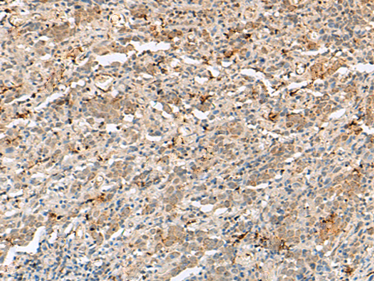 Immunohistochemistry of paraffin-embedded Human cervical cancer tissue  using H3F3B Polyclonal Antibody at dilution of 1:40(×200)