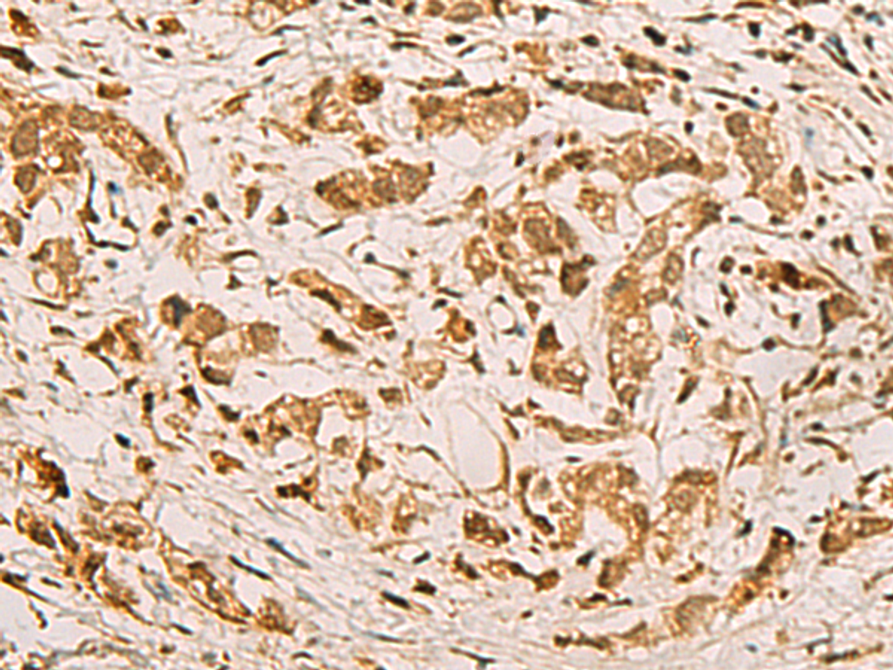 Immunohistochemistry of paraffin-embedded Human gastric cancer tissue  using ZMAT4 Polyclonal Antibody at dilution of 1:65(×200)