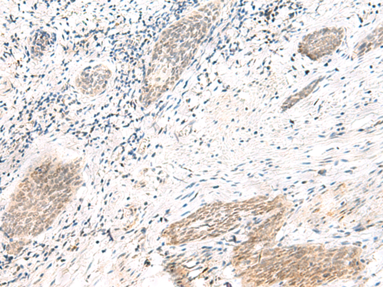 Immunohistochemistry of paraffin-embedded Human esophagus cancer tissue  using ARL2BP Polyclonal Antibody at dilution of 1:50(×200)